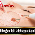 Cara Menghilangkan Tahi Lalat secara Alami dan Medis