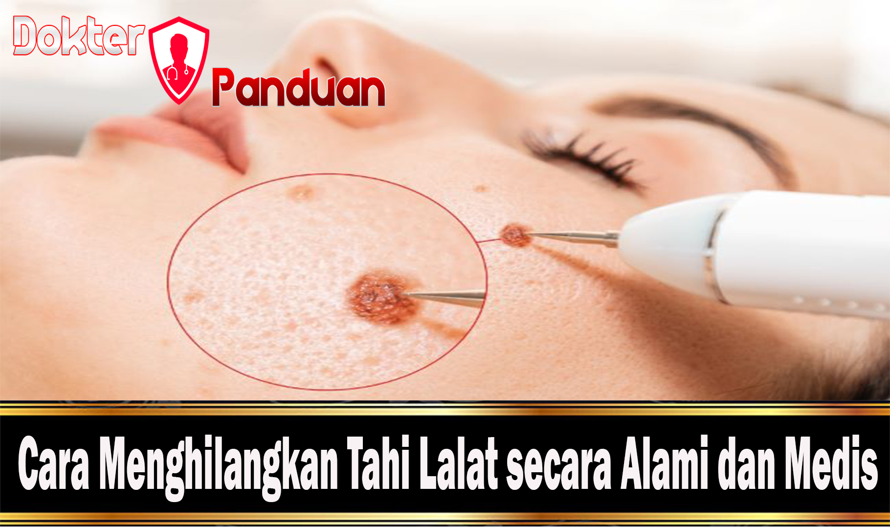 Cara Menghilangkan Tahi Lalat secara Alami dan Medis