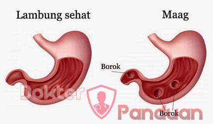 Maag Bukan Takdir! Cegah dan Atasi dengan Gaya Hidup Sehat