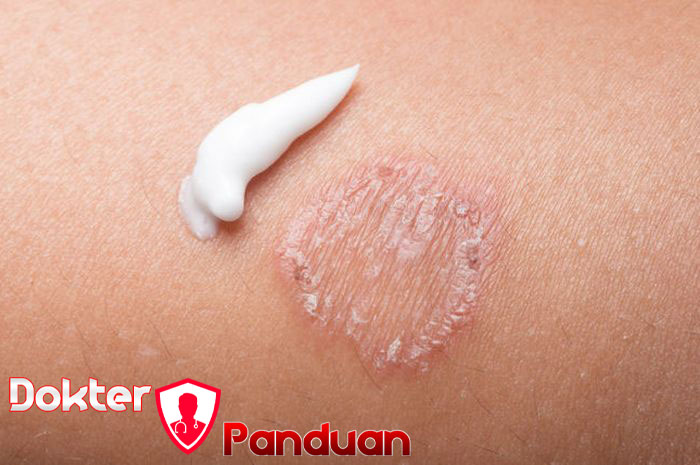  Obat Ampuh untuk Kudis